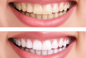 Teeth whitening can cause permanent damage - Canadian expert